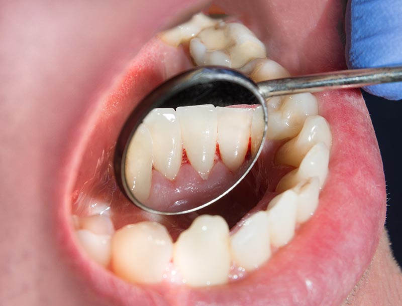 Clean teeth after a professional dental cleaning at Parliament Street Dentistry