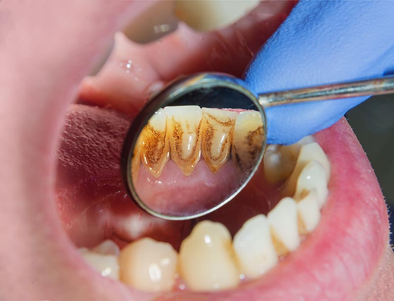 Teeth with plaque and tartar before a professional dental cleaning in Toronto