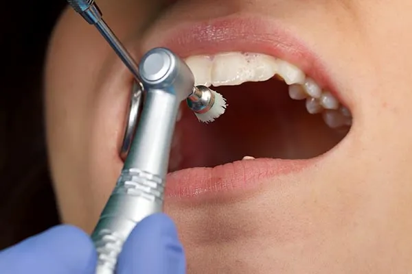 Dental cleaning and checkup at a family dentist in Cabbagetown, Toronto